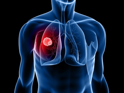 Albertinen Krankenhaus - Albertinen Tumorzentrum - Krebs im Bereich der Lunge - Krebs am Rippenfell