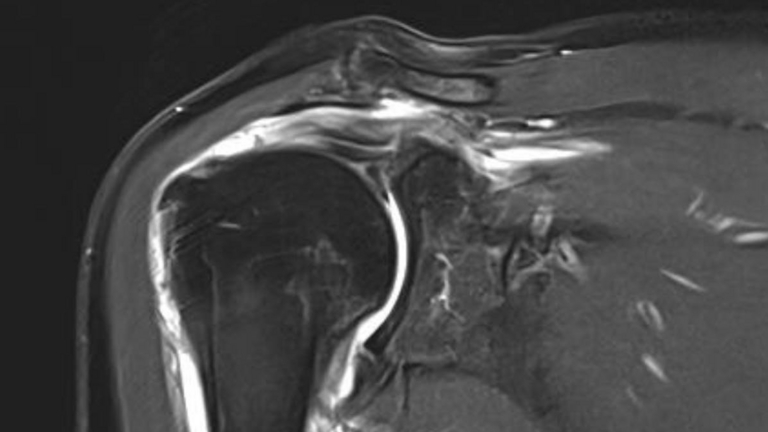Rotatorenmanschettenrisse-Schulter-Diagnose-Handball-Doc