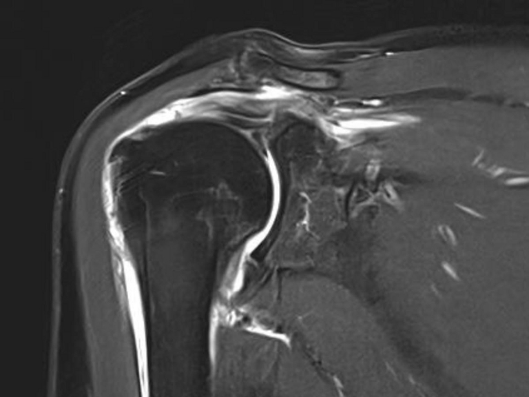 Rotatorenmanschettenrisse-Schulter-Diagnose-Handball-Doc