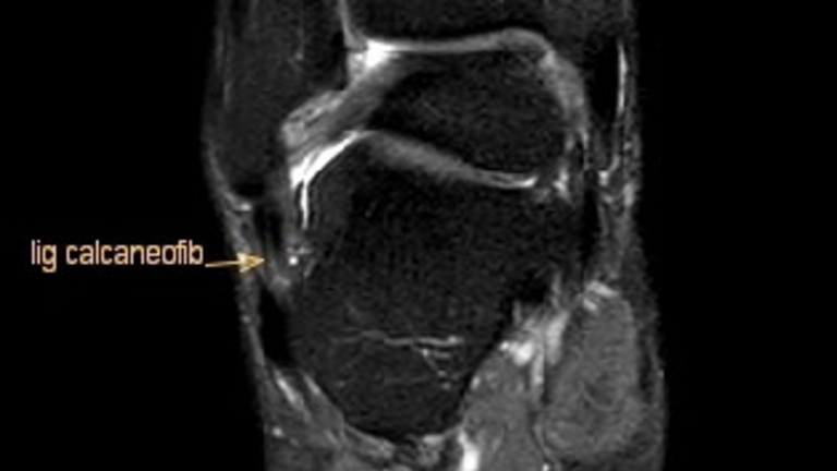 Zerrung Außenband, MRT, Handball-Doc Zerrung Außenband, MRT, Handball-Doc