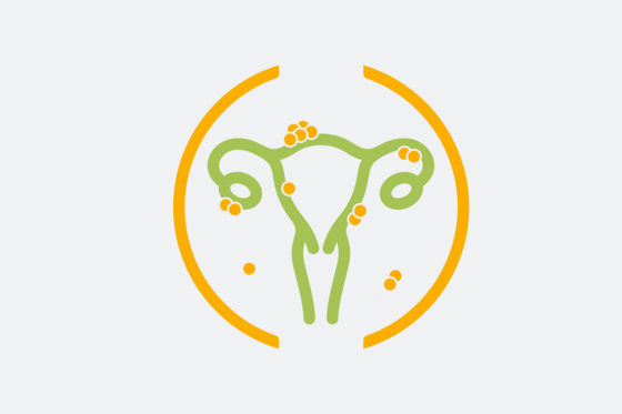 Grafische Darstellung Gebärmutter und Eierstöcke, Endometriosezentrum