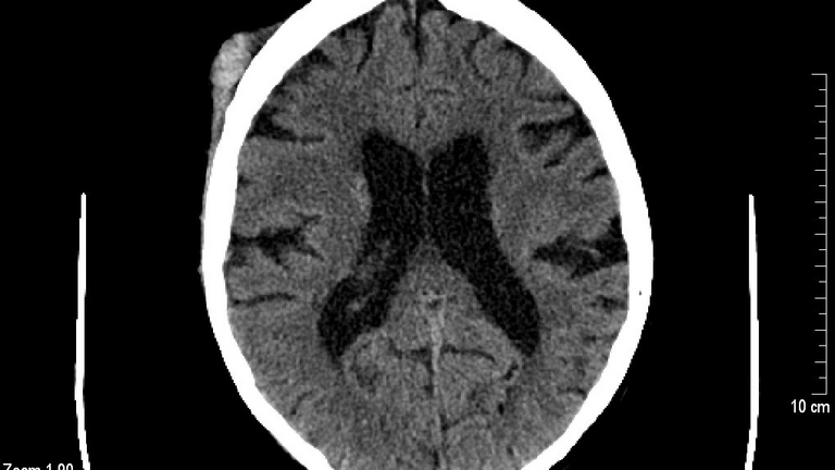 CT-Aufnahme des menschlichen Gehirns mit deutlich sichtbaren Hirnstrukturen und veränderten Kontrastbereichen; medizinische Bildgebung im Kontext von Kopfverletzungen und Gehirnerschütterung im Handball-Sport.